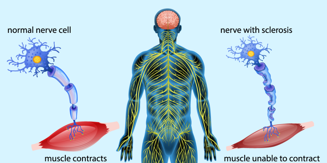 Amyotrophic lateral sclerosis (ALS)