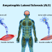 Amyotrophic lateral sclerosis (ALS)