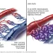 AVM blood flow
