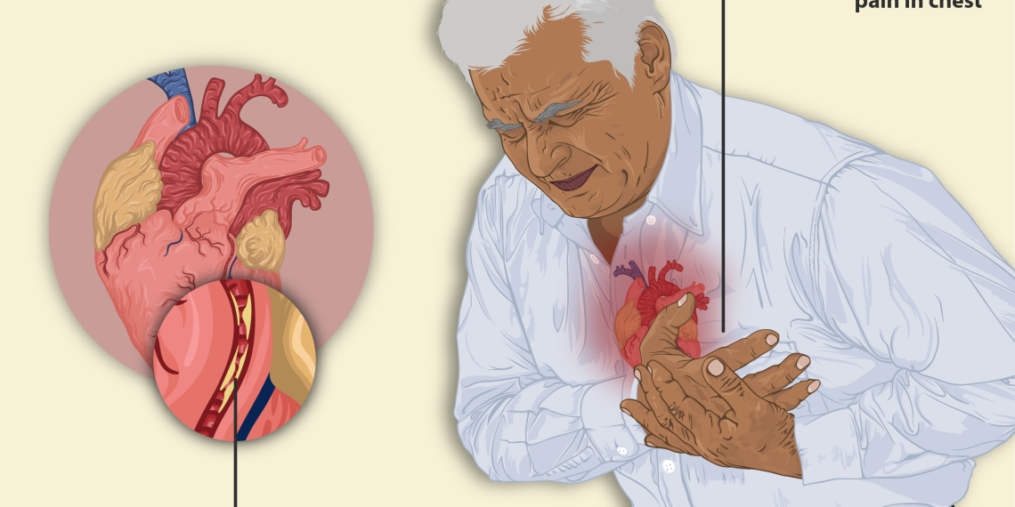 Angina