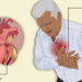 Angina