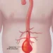 Abdominal aortic aneurysm