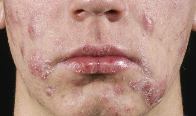 Acne