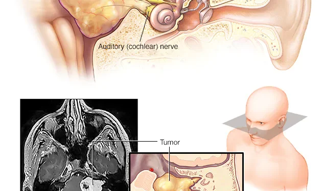 Acoustic neuroma