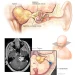 Acoustic neuroma