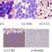 Acute Lymphocytic Leukemia (ALL)