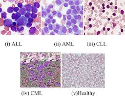 Acute Lymphocytic Leukemia (ALL)
