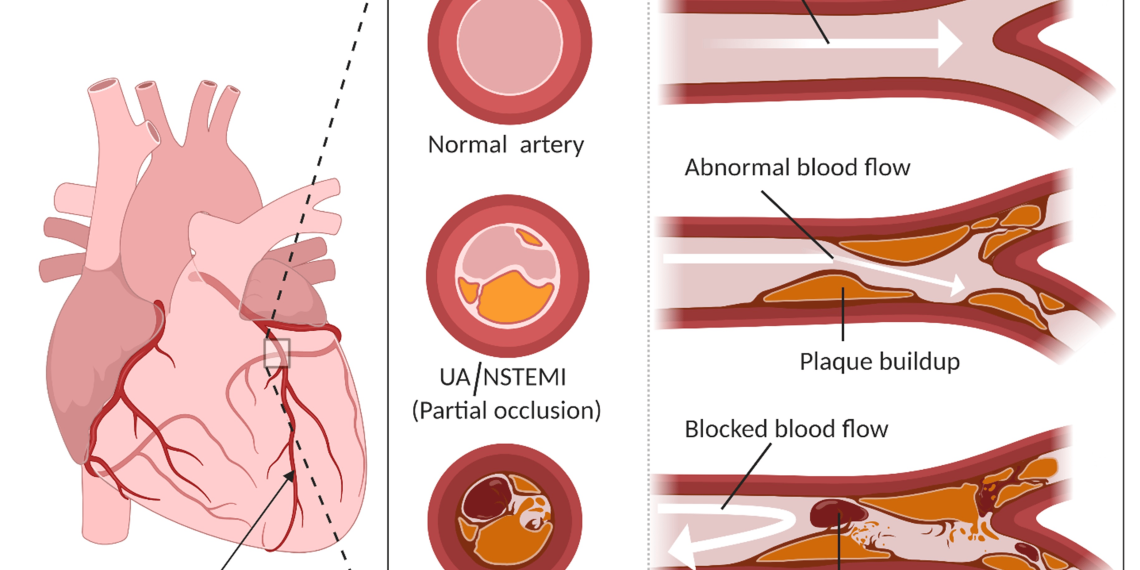 Acute coronary syndrome