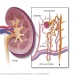 Acute kidney injury