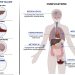 Acute liver failure