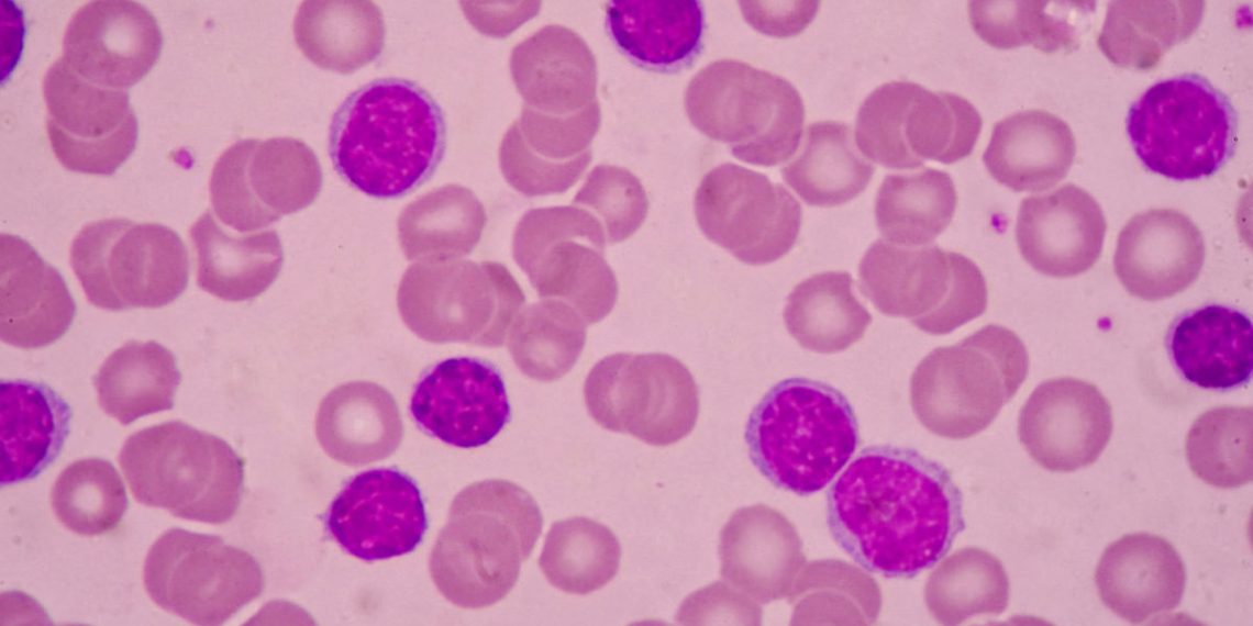 Acute myelogenous leukemia