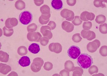 Acute myelogenous leukemia