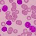 Acute myelogenous leukemia