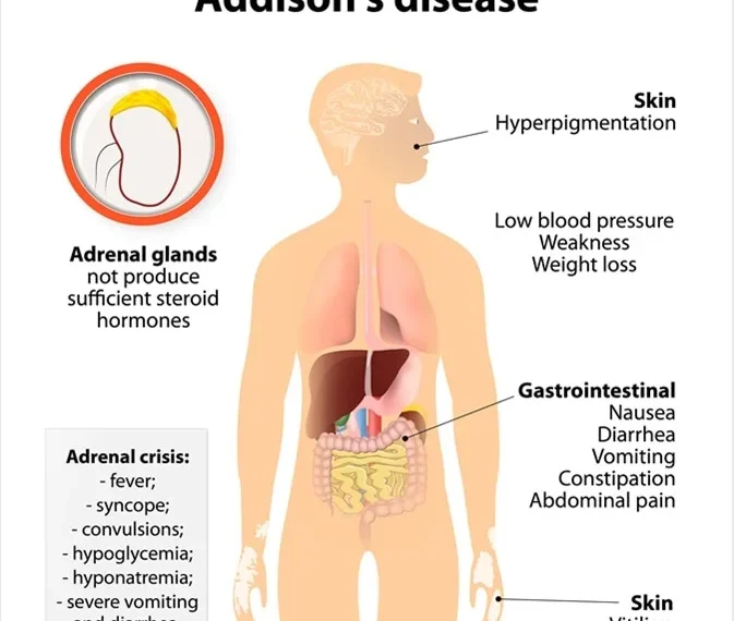 Addison's Disease