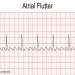 Atrial Flutter