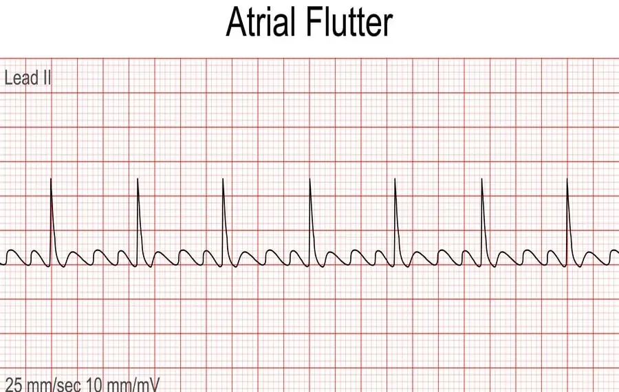 Atrial Flutter