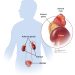 Adrenal Cancer