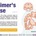 Alzheimer's disease