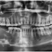 Ameloblastoma