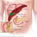 Ampullary Cancer