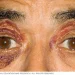 Amyloidosis