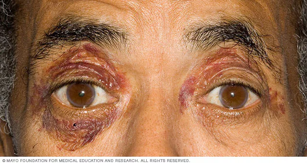 Amyloidosis