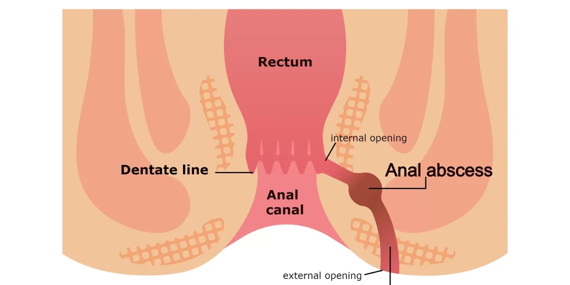 Anal Fistula