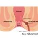 Anal Fistula