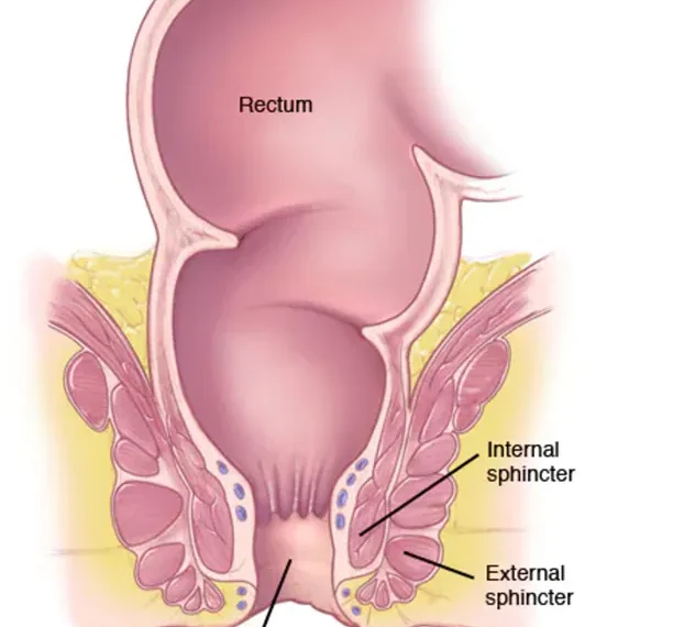 Anal cancer