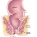 Anal cancer