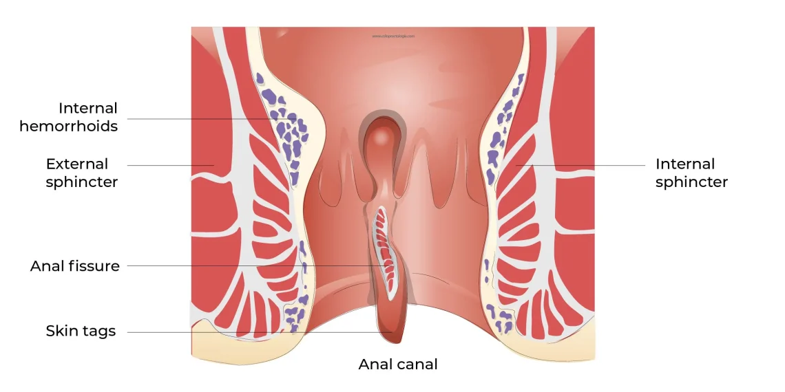 Anal fissure