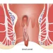 Anal fissure