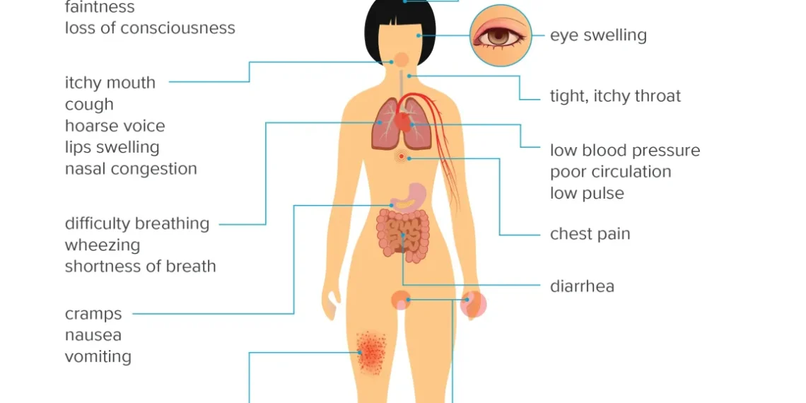 Anaphylaxis