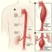 Aneurysms