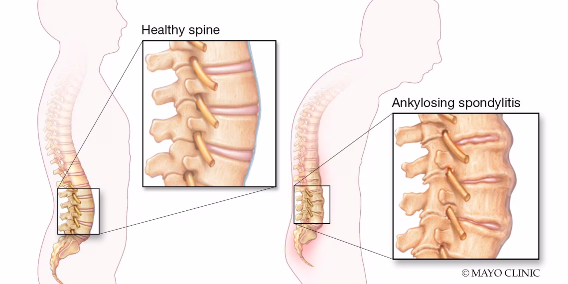 Ankylosing spondylitis