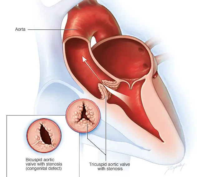 Aortic Valve Disease