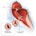 Aortic Valve Disease