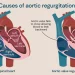 Aortic Valve Regurgitation