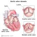 Aortic Valve Stenosis