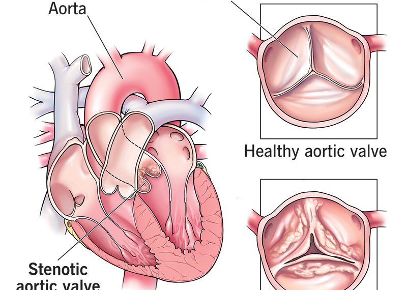 Aortic Valve Stenosis