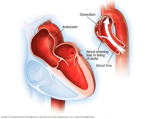 Aortic aneurysm