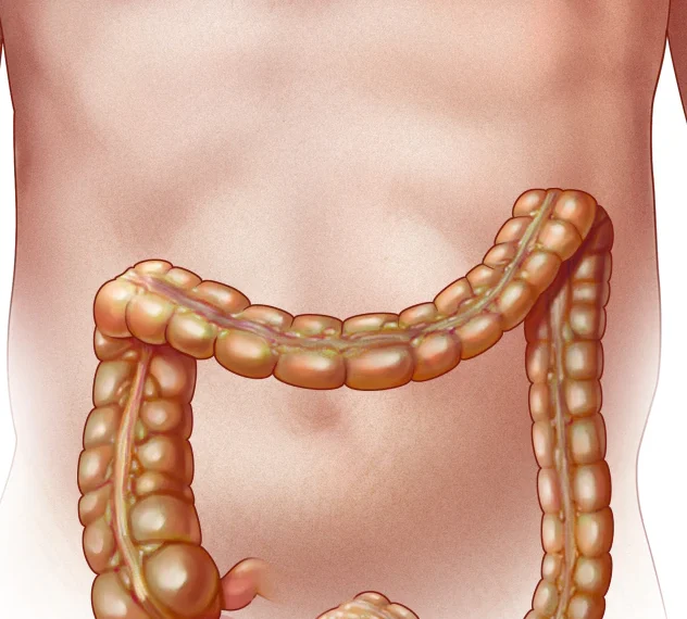 Appendicitis