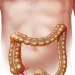 Appendicitis