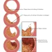 Arteriosclerosis and Atherosclerosis