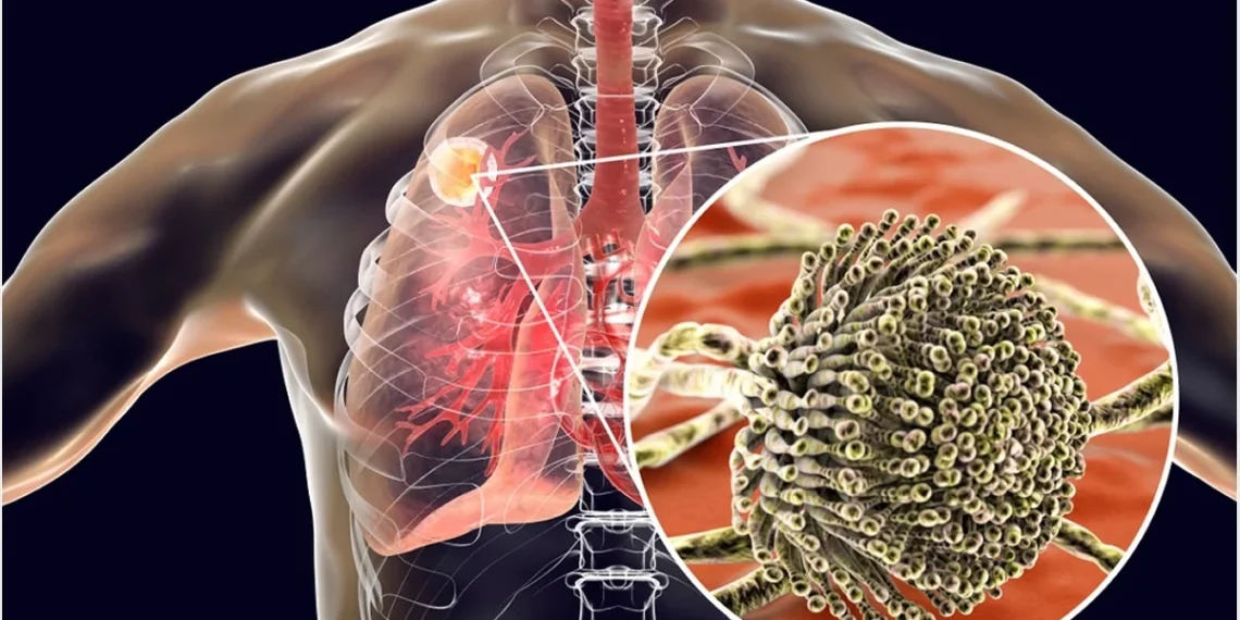 Aspergillosis