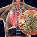 Aspergillosis