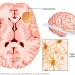 Astrocytoma