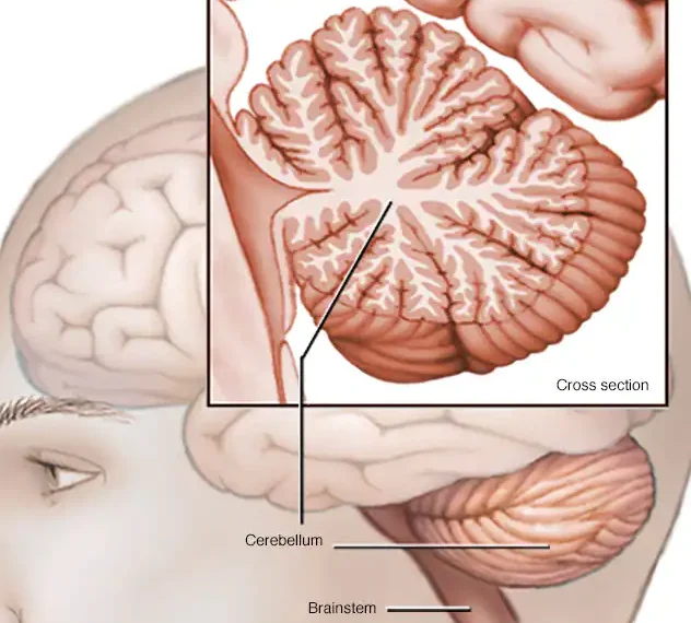 Ataxia