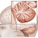 Ataxia