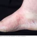 Athlete’s Foot (Tinea Pedis)
